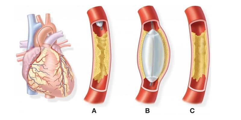 Pengobatan Angin Duduk