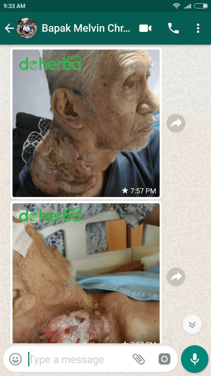 Kanker di Leher yang Semakin Membesar Kanker di leher