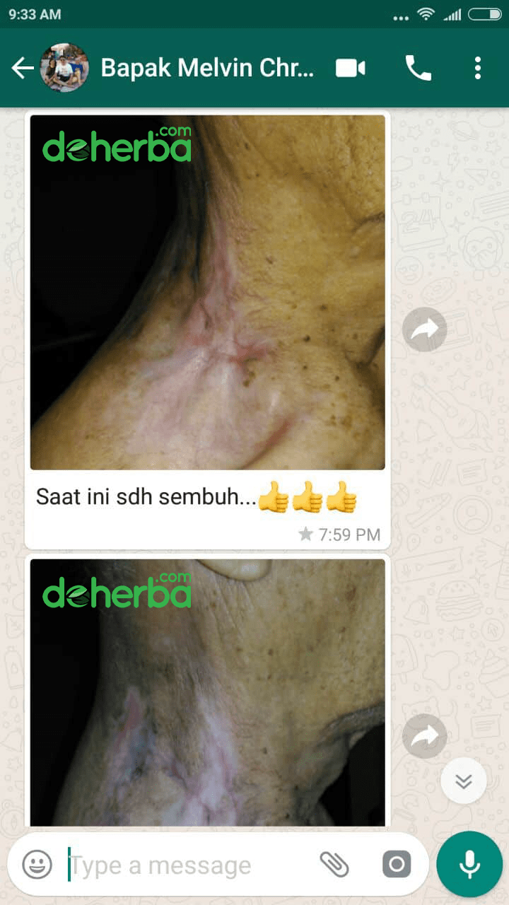 Kanker Hilang Berkat Obat Kanker Alami Kanker punah berkat obat kanker alami