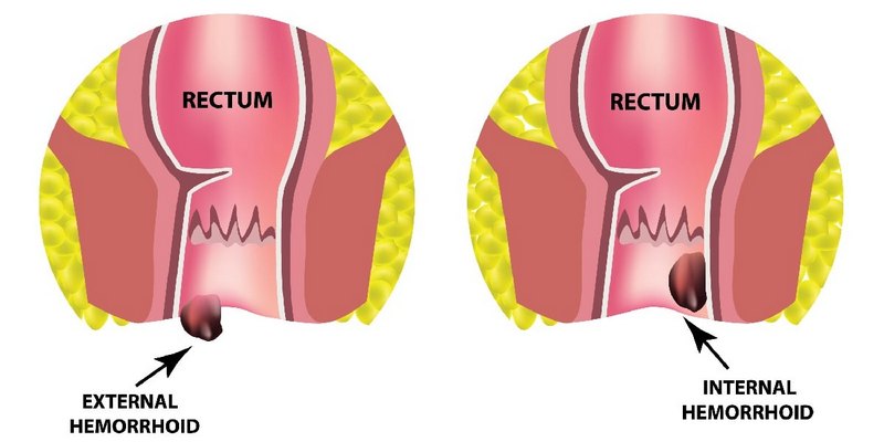 Ambeien Luar vs Ambeien Dalam