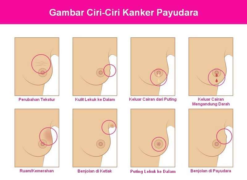 Gambar Ciri-Ciri Kanker Payudara yang Mudah Dikenali