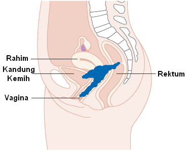 Gambar Kanker Serviks Stadium 4 A