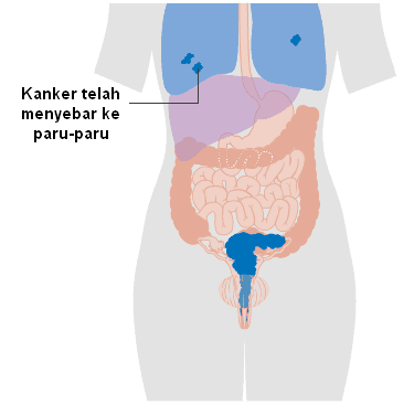 Gambar Kanker Serviks Stadium 4 B