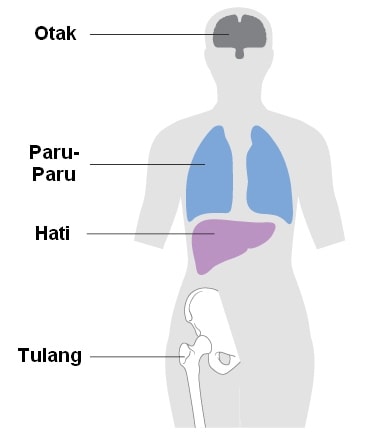 Penyebaran Kanker Payudara Stadium 4