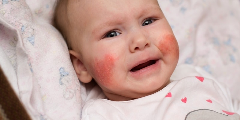 penyakit eksim - penyakit kulit eksim - eksim kering - eksim basah - eksim kulit