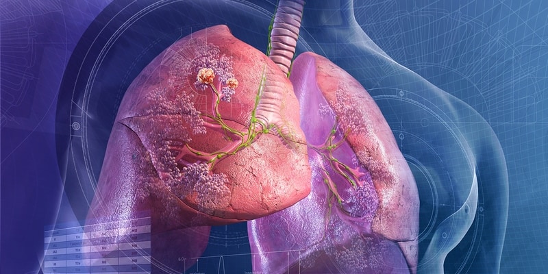akibat kanker paru-paru - kanker paru-paru - efek penyakit paru-paru - organ paru-paru