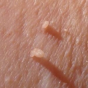 ciri-ciri daging tumbuh - penyebab daging tumbuh - cara menghilangkan daging tumbuh