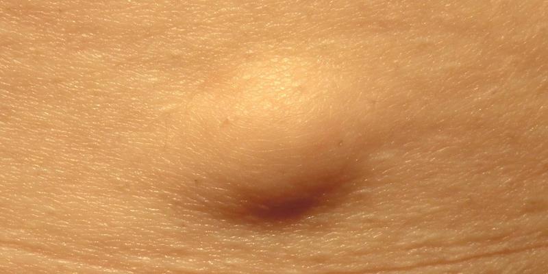 ciri-ciri tumor ganas - penyebab tumor ganas - perbedaan tumor jinak dan ganas - obat tumor ganas