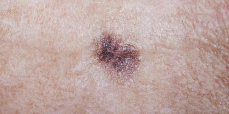 penyebab flek hitam di wajah - penghilang flek hitam di wajah - menghilangkan flek hitam di wajah