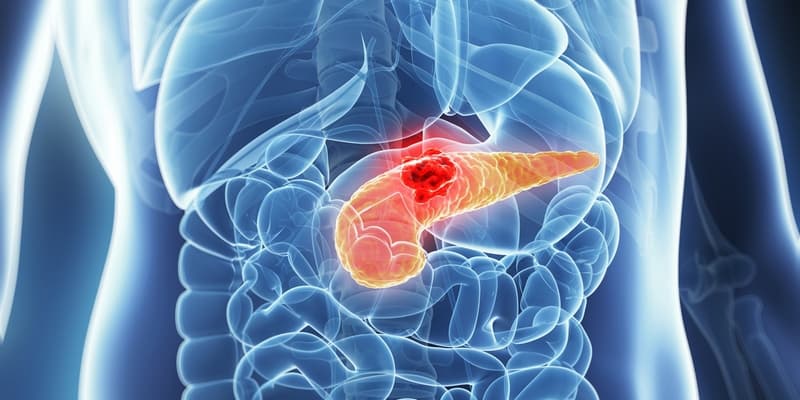 penyakit pankreas - penyakit kanker pankreas - penyebab kanker pankreas