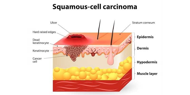 kanker karsinoma - karsinoma sel basal - karsinoma sel skuamosa - adenokarsinoma