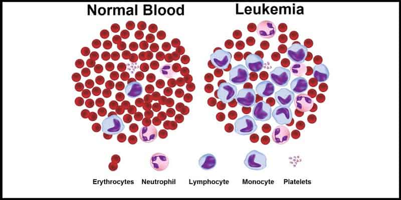 Penyakit Kanker Darah - Penyakit Kanker Leukemia