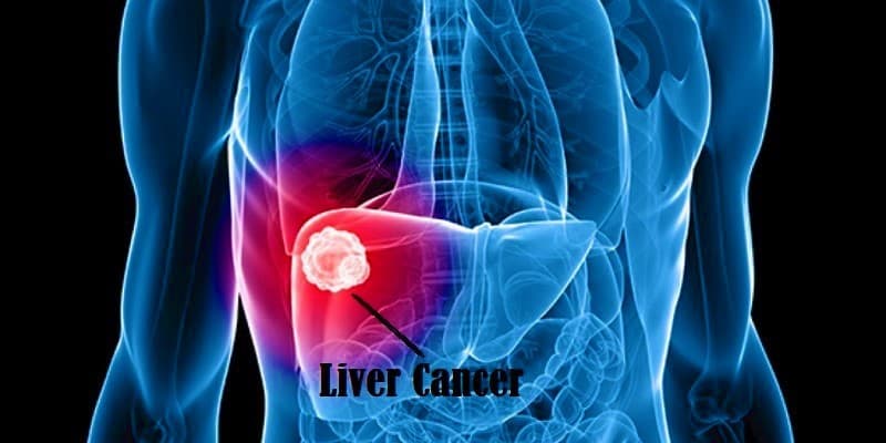 Penyakit Kanker Hati Pada Pria