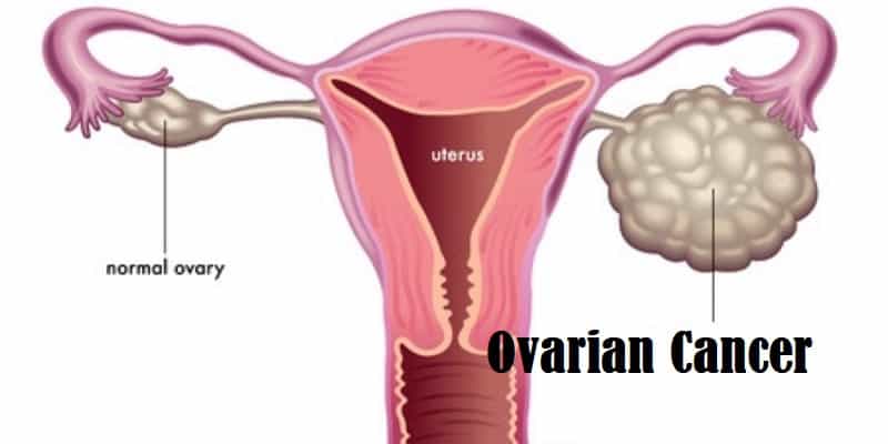 Penyakit Kanker Indung Telur Pada Wanita