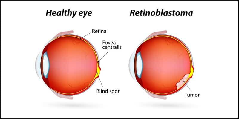 Penyakit Kanker Mata - Penyakit Kanker Retinoblastoma