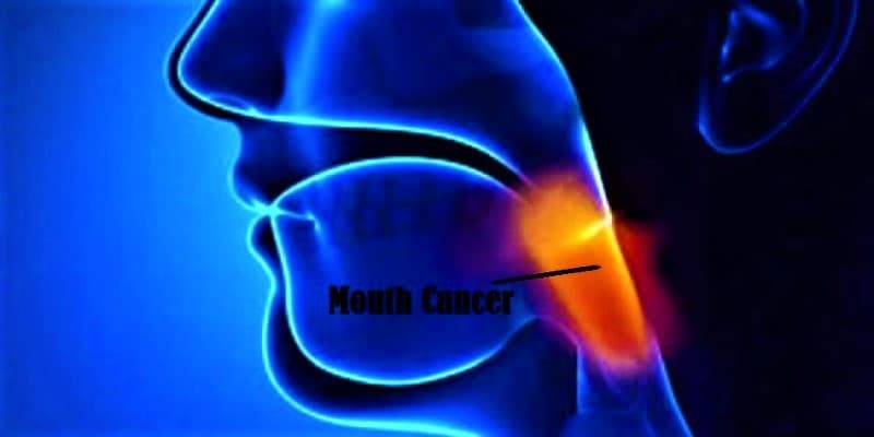 Penyakit Kanker Mulut Pada Pria