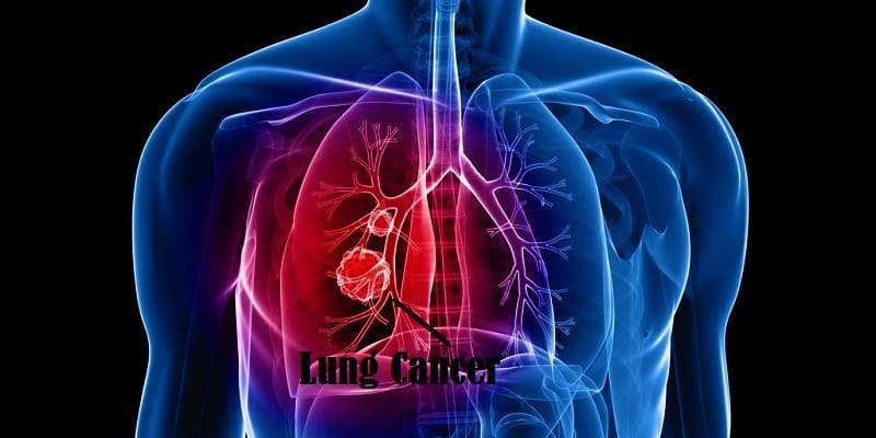 Penyakit Kanker Paru-Paru Pada Pria