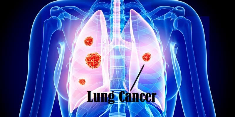 Penyakit Kanker Paru-Paru Pada Wanita