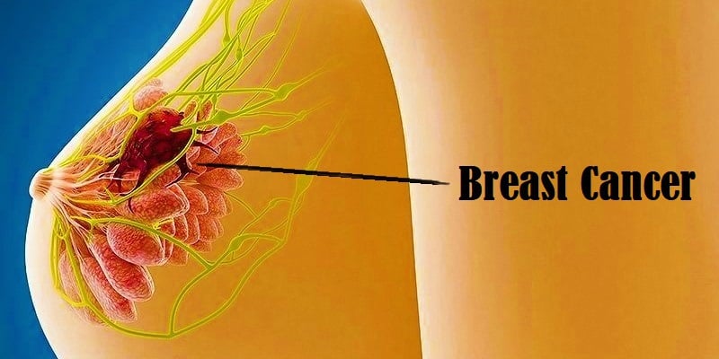 Penyakit Kanker Payudara Pada Wanita