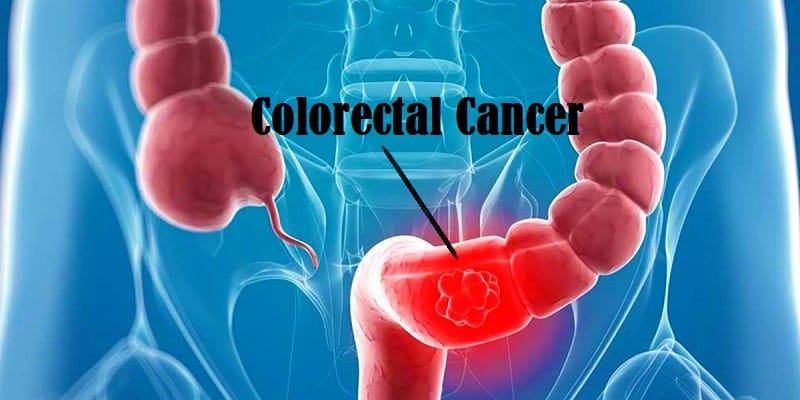 Penyakit Kanker Usus Pada Wanita