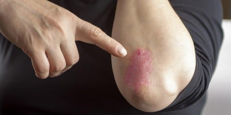 Ilustrasi gejala psoriasis