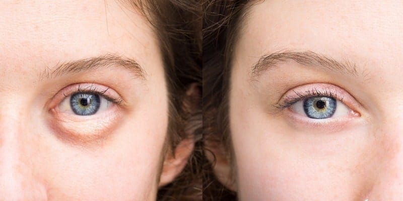 kantung mata bengkak - penyebab kantung mata - cara alami menghilangkan kantung mata - masker kantung mata