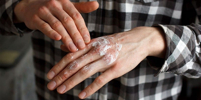 Ilustrasi krim untuk pengobatan psoriasis