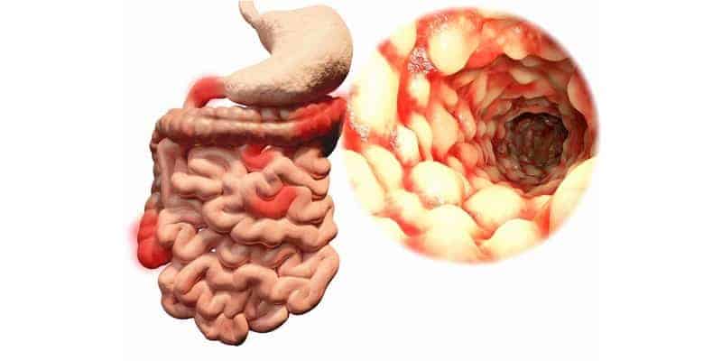 penyakit radang usus - radang usus besar - gejala radang usus - penyebab radang usus - cara mengobati radang usus