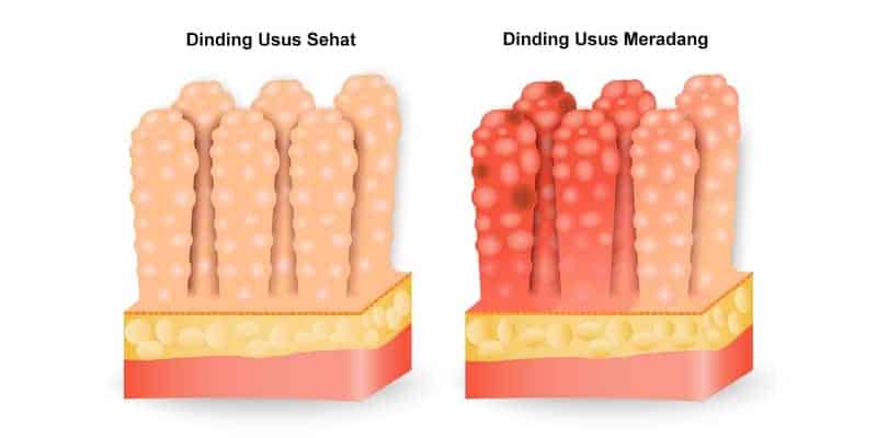 penyakit muntaber - gejala muntaber - penyebab muntaber - cara mengobati muntaber