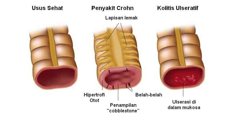 penyakit radang usus - radang usus besar - gejala radang usus - penyebab radang usus - cara mengobati radang usus