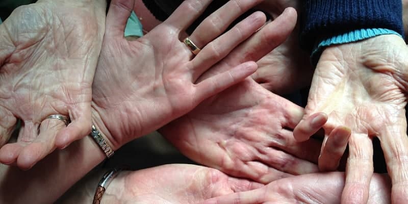 telapak tangan dengan dupuytren