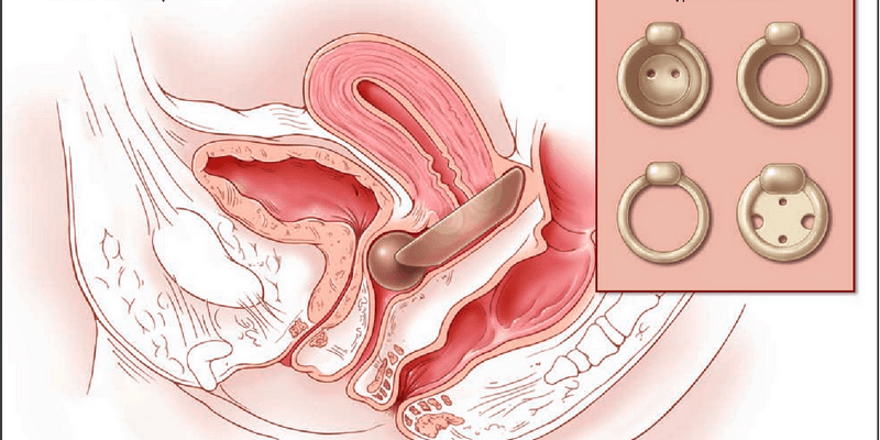 cara mengatasi peranakan turun dan penyebab turun peranakan