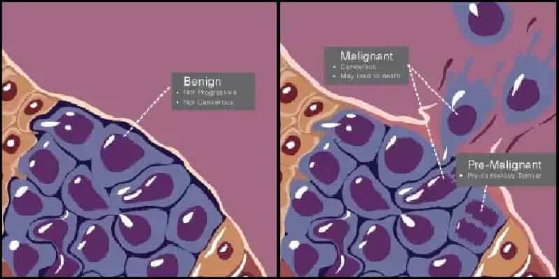 beda tumor dan kanker