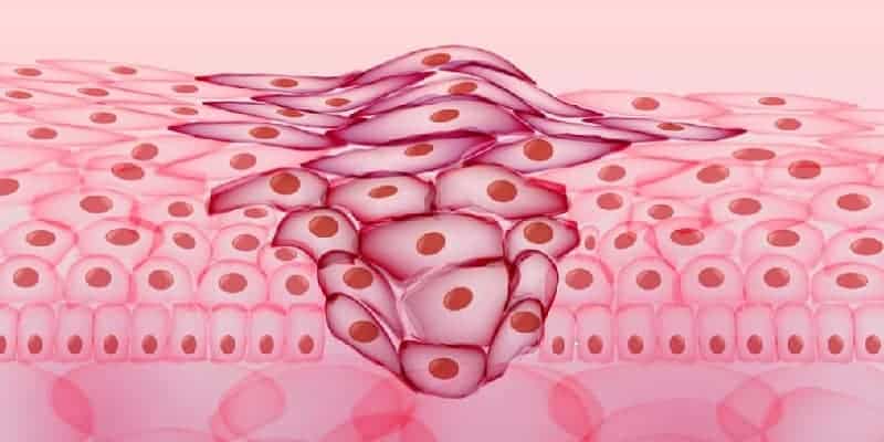 ciri bentuk sel kanker