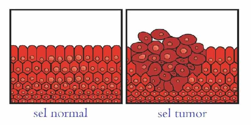 sel tumor penyebab tumor jinak