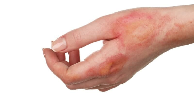 luka tersiram air panas