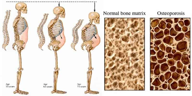 Kondisi Tulang Keropos