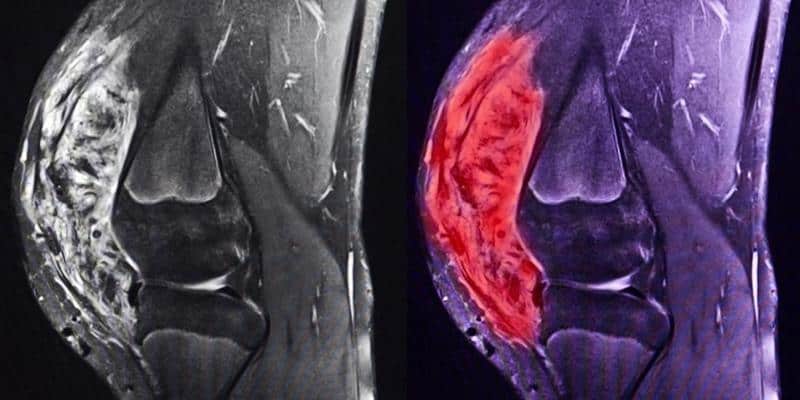 hasil MRI sarkoma di lutut