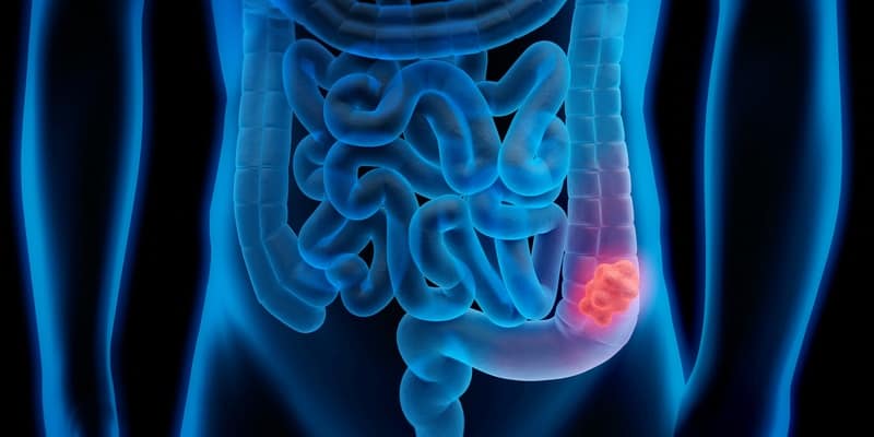 ilustrasi kanker usus besar