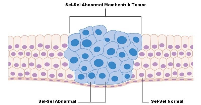 pembentukan tumor