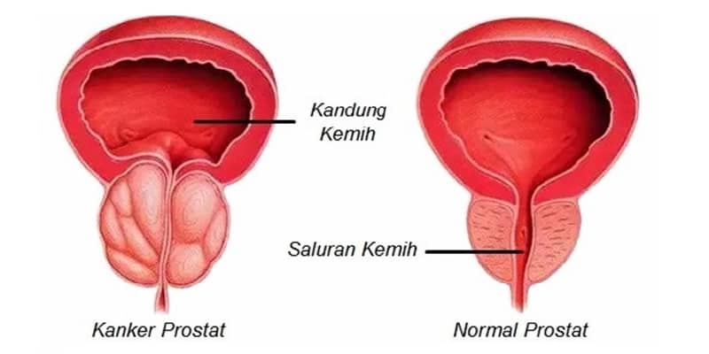 kanker prostat adalah, apa itu kanker prostat, tentang kanker prostat, definisi kanker prostat