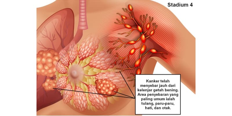 Foto Kanker Payudara Stadium 4