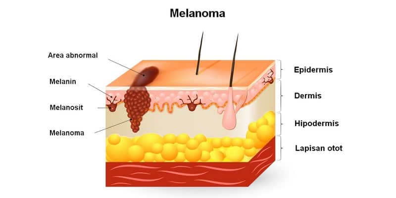 jenis kanker kulit melanoma