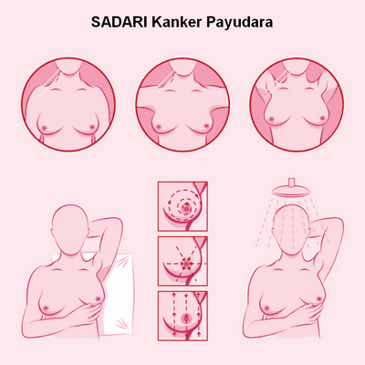 SADARI kanker payudara