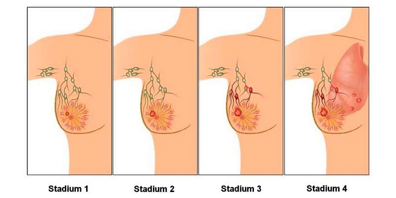 Foto Ilustrasi Stadium Kanker Payudara 1 - 4