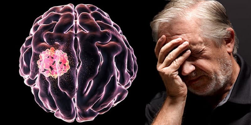 Ilustrasi Gejala Kanker Otak Stadium 3