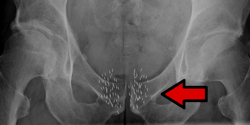 Radioterapi Kanker Internal