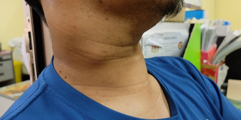 Gambar Ilustrasi Benjolan Kanker Nasofaring