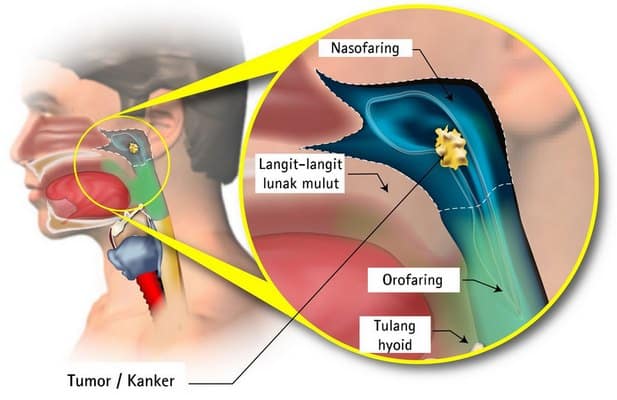 Gambar Kanker Nasofaring