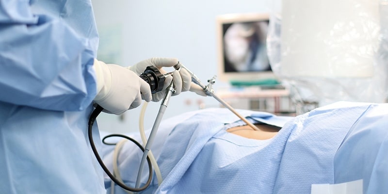 Ilustrasi Operasi dengan Endoskopi (Laparoskopi)